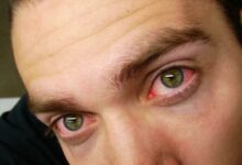 Photo of 5 Ways To Get Rid of Red Eye From Consuming Marijuana